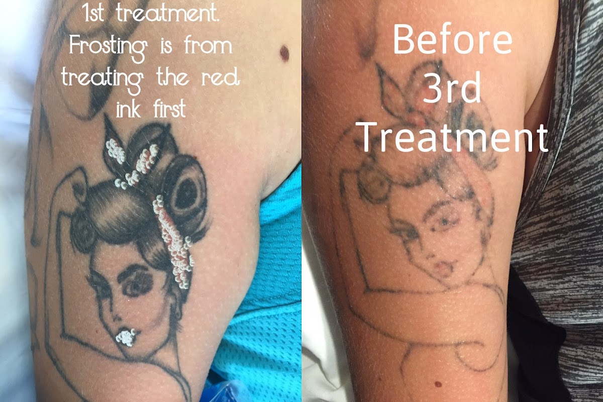 deINK Tattoo Removal — laser tattoo removal clinic in Morningside