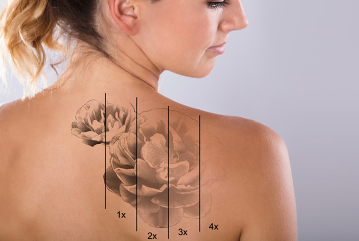 Transform Clinic Dunedin — laser tattoo removal clinic in Dunedin