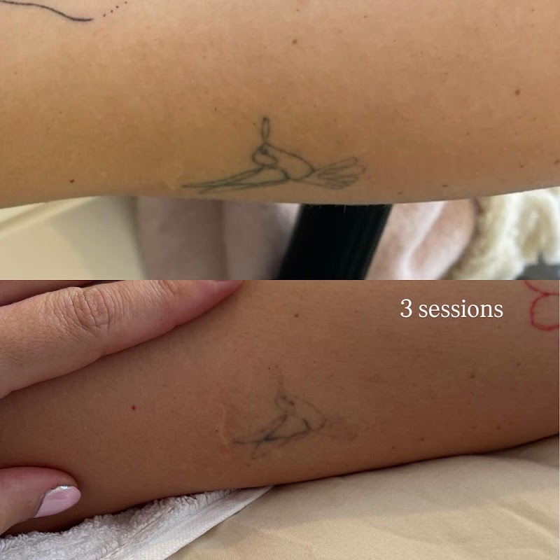 Salt Aesthetics NZ — laser tattoo removal clinic in Papamoa Beach
