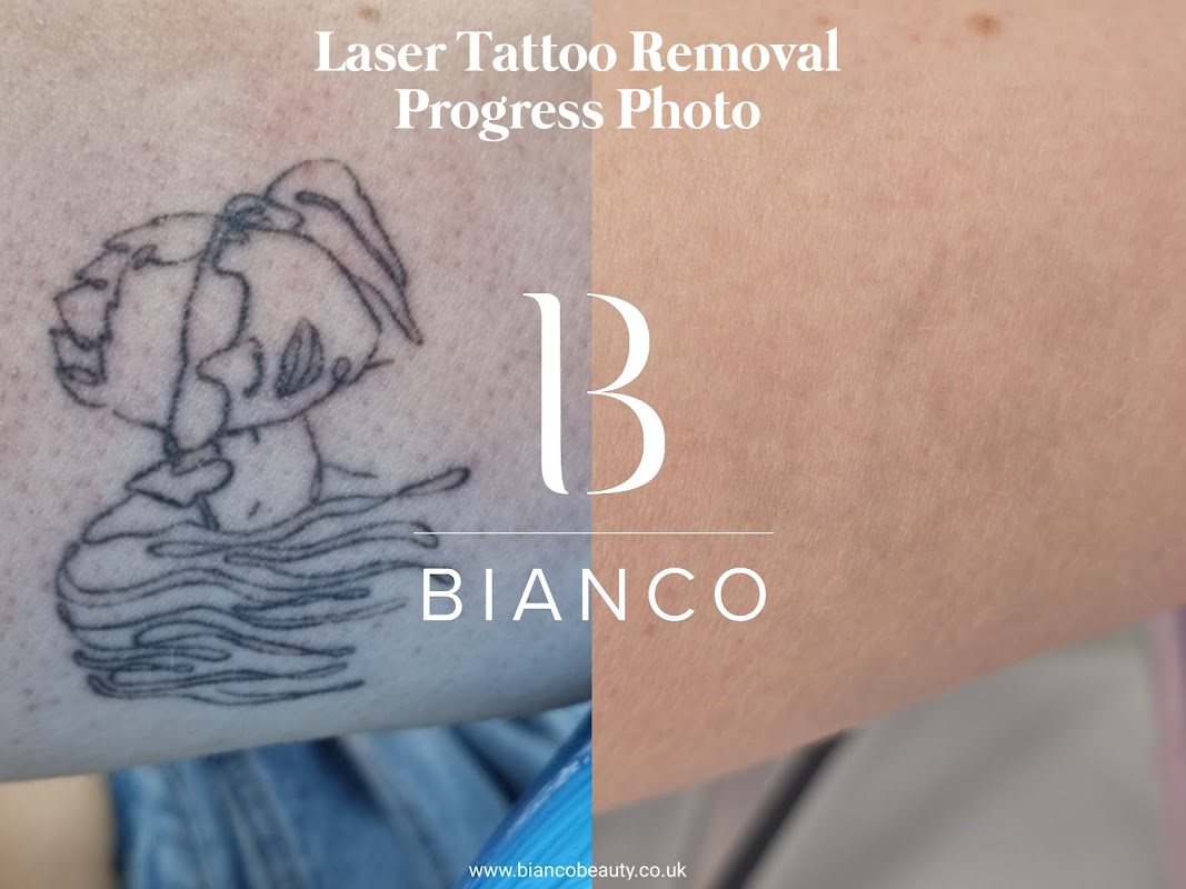 Bianco Beauty Milton Keynes — laser tattoo removal clinic in Milton Keynes