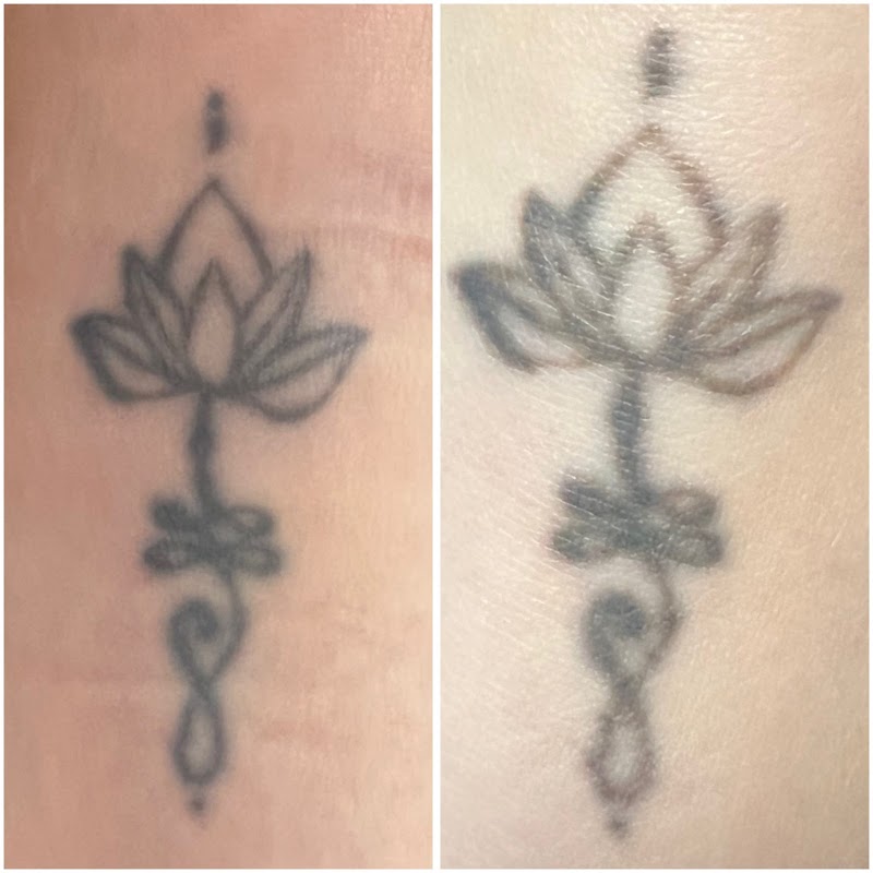 Traceless laser — laser tattoo removal clinic in Birmingham