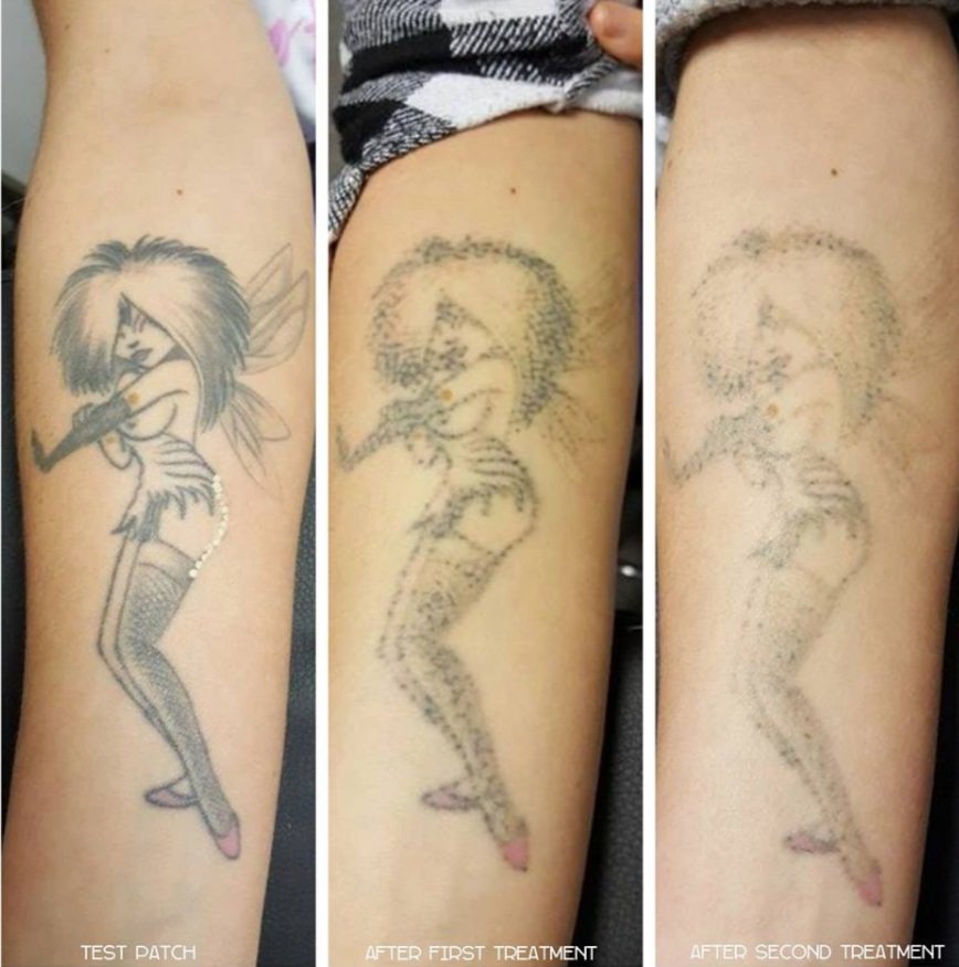 Chameleon Tattoo — laser tattoo removal clinic in Paisley
