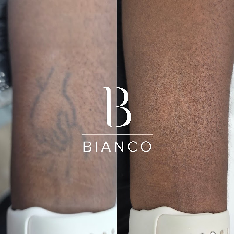 Bianco Beauty Manchester — laser tattoo removal clinic in Manchester