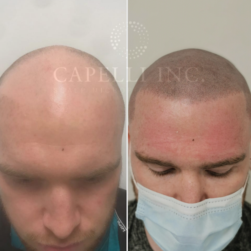 Capelli Inc — laser tattoo removal clinic in Liverpool
