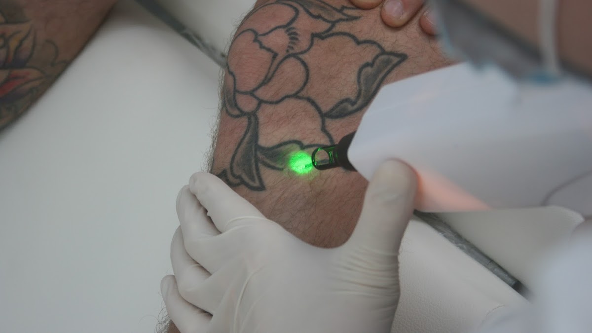 Plymouth Tattoo Removal & Laser aesthetics Ltd — laser tattoo removal clinic in Plymouth