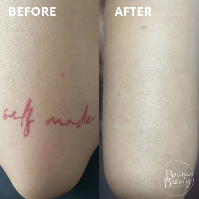 Bourne Beauty Laser Tattoo Removal — laser tattoo removal clinic in Stockport