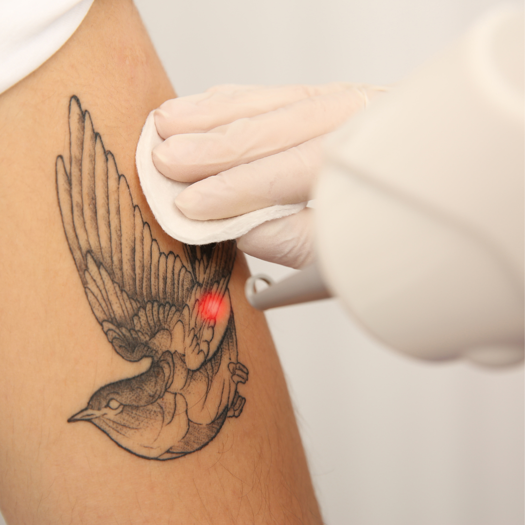 Noire Wellness and Aesthetics β laser tattoo removal clinic in Lyndhurst