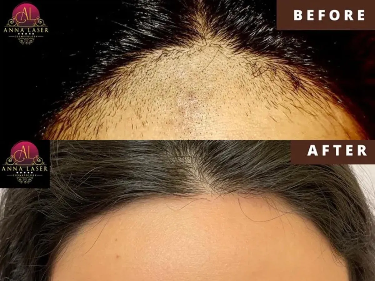 Anna Laser Cosmetology and Laser Hair Removal — laser tattoo removal clinic in Brooklyn