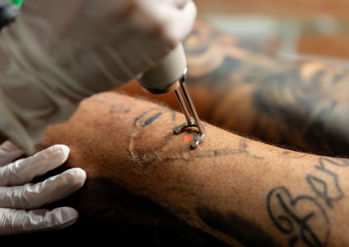 Legendary Laser Tattoo Removal — laser tattoo removal clinic in Fort Worth