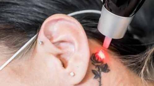 Laser Lounge Dallas — laser tattoo removal clinic in Dallas