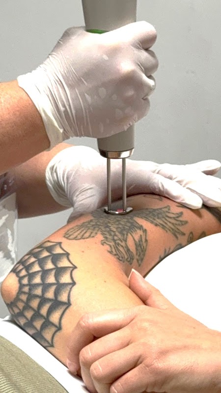 Erase & Renew Laser Tattoo Removal β laser tattoo removal clinic in Gallatin
