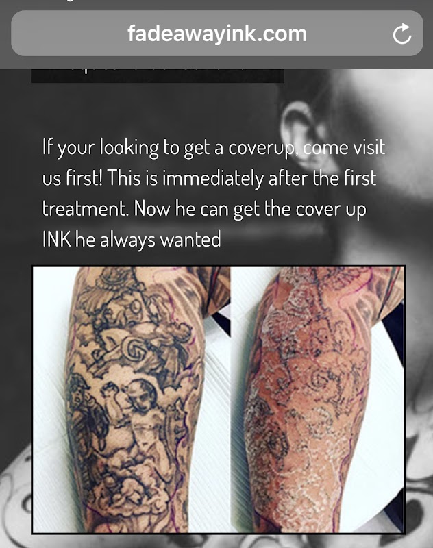 FadeAway INK. โ laser tattoo removal clinic in Staten Island