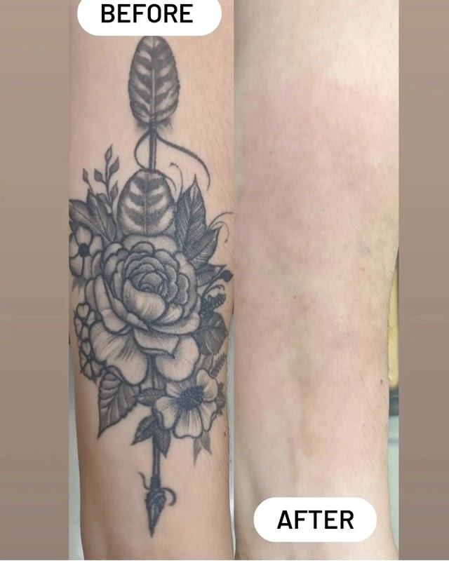 Bonsai Laser Tattoo Removal β laser tattoo removal clinic in Rowlett