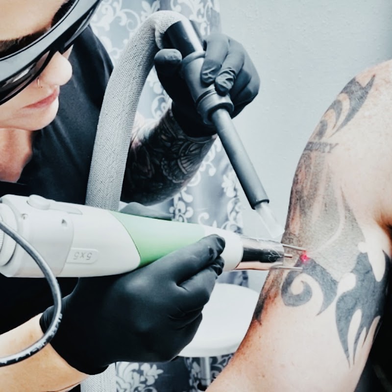 Denton Laser Tattoo Removal — laser tattoo removal clinic in Denton