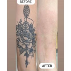 Bonsai Laser Tattoo Removal — laser tattoo removal clinic in Frisco