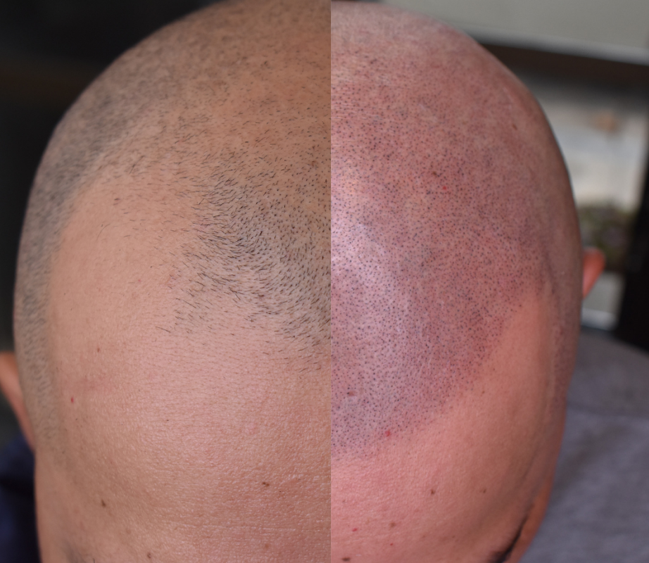 The Scalp Barber Scalp Micropigmentation Hair Loss Solution By Allure — laser tattoo removal clinic in Sacramento