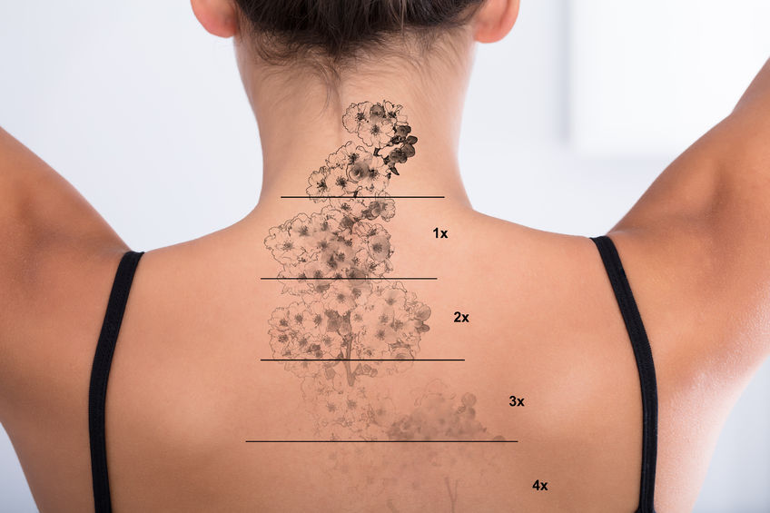 Tattoos Be Gone Las Vegas — laser tattoo removal clinic in Las Vegas