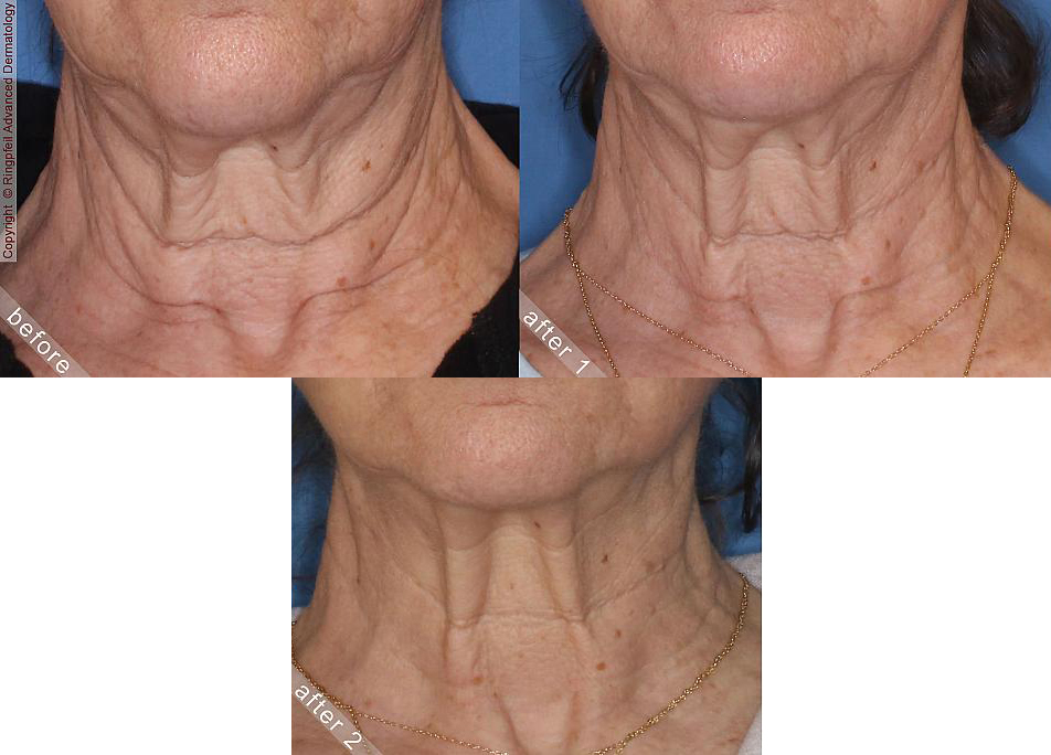 Ringpfeil Advanced Dermatology โ laser tattoo removal clinic in Philadelphia