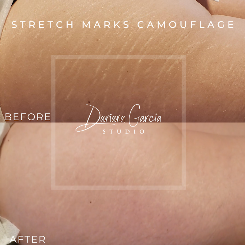 Dariana Garcia Chicago - Stretch Marks and Scars Camouflage β laser tattoo removal clinic in Chicago