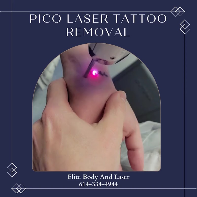 Elite Body & Laser Center — laser tattoo removal clinic in Columbus