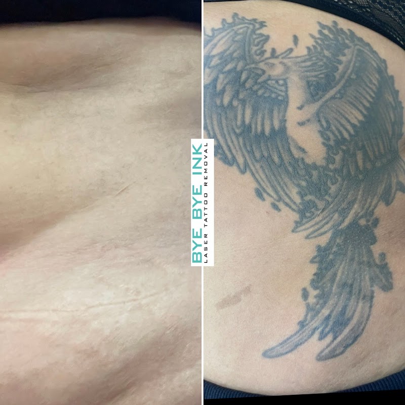 Bye Bye Ink Laser Tattoo Removal — laser tattoo removal clinic in Middle Village