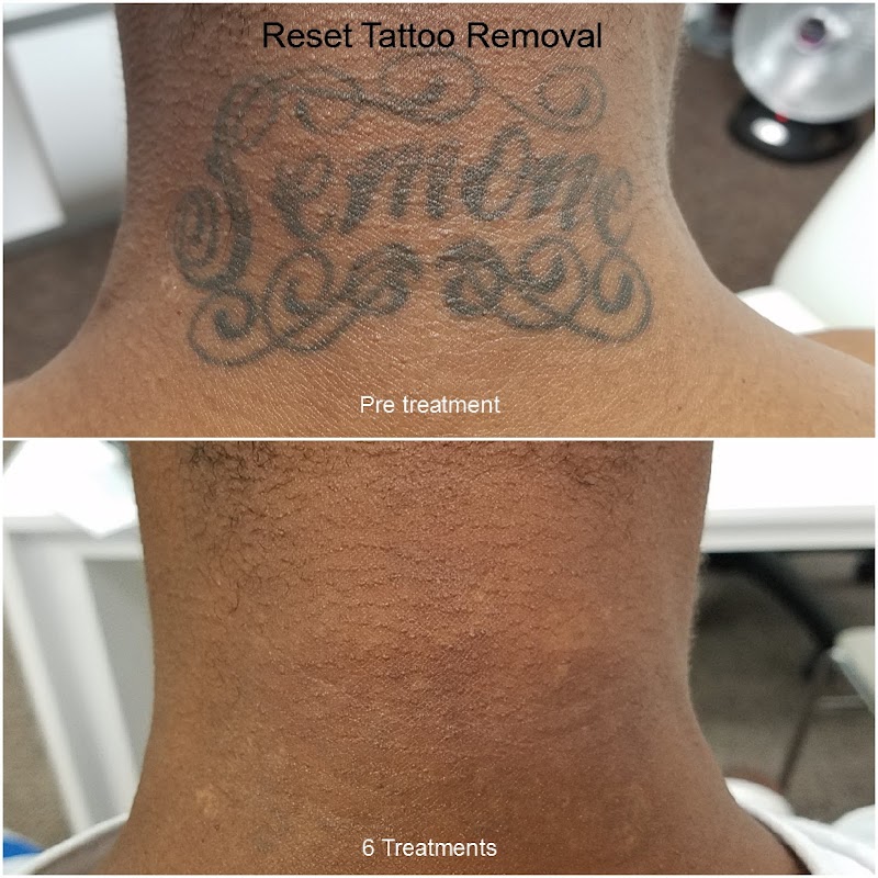 Reset Tattoo Removal β laser tattoo removal clinic in Las Vegas