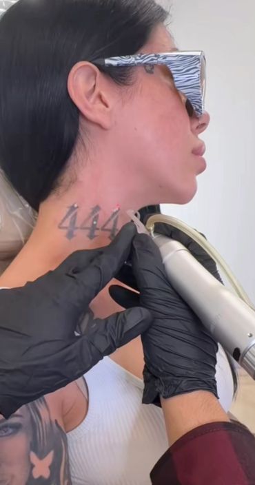 Tattoo Removal OC β laser tattoo removal clinic in Orange