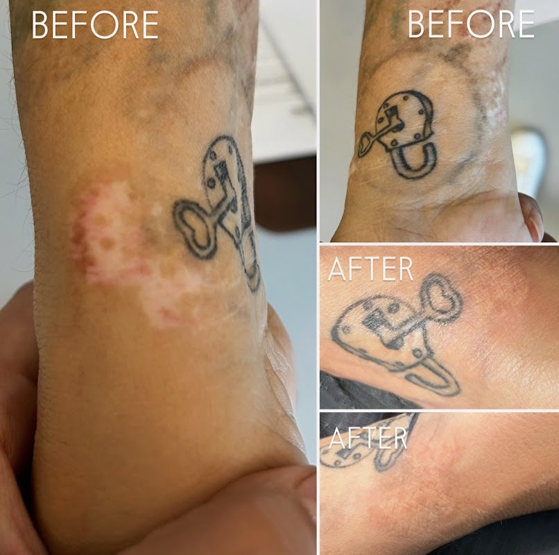 Posh Beauty Permanent Makeup & Scar Camouflage Clinic — laser tattoo removal clinic in Henderson