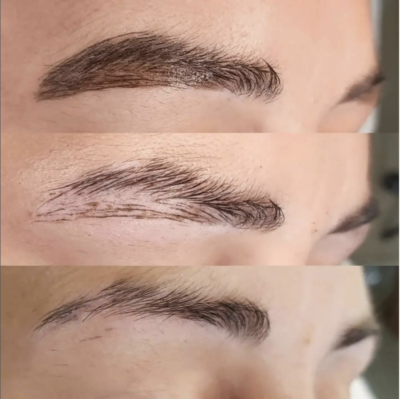 Tattoo Removal by Sparrow — laser tattoo removal clinic in San Antonio