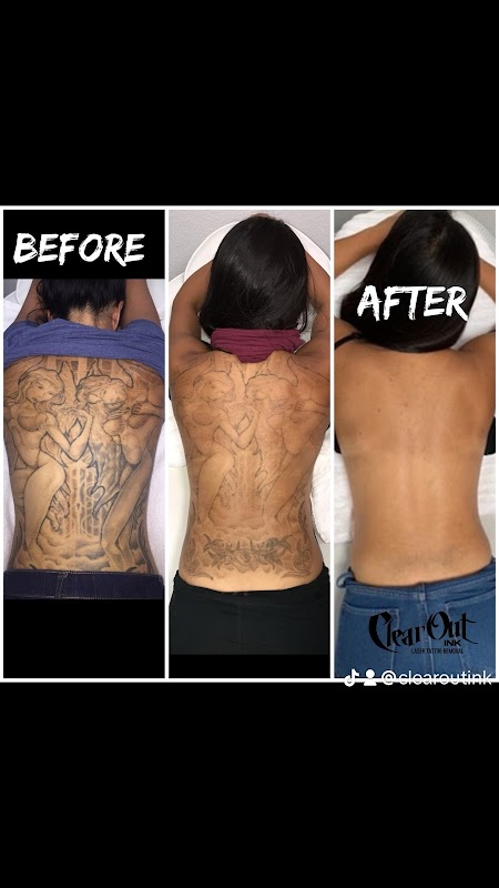 Clear Out Ink Laser Tattoo Removal — laser tattoo removal clinic in Henderson