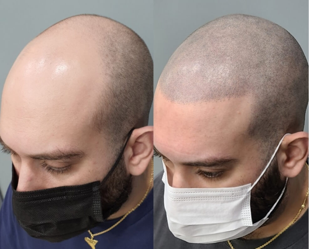 Cosmotek Masterclass — laser tattoo removal clinic in San Jose