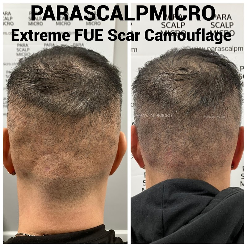 Parascalpmicro Institute-Scalp & Scar Clinic — laser tattoo removal clinic in New York