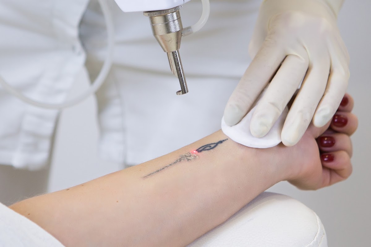 LaserAll β laser tattoo removal clinic in Centennial