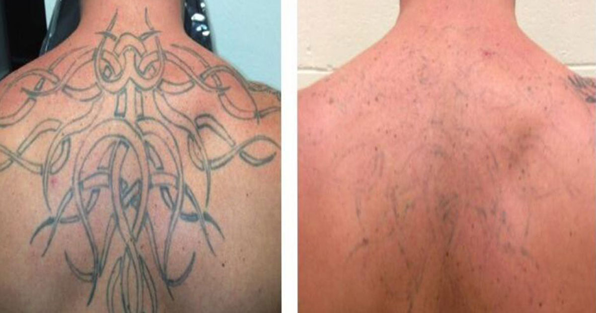 El Beauty Station LLC — laser tattoo removal clinic in Denver