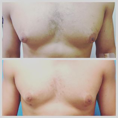 la Piel Perfecta Laser Center β laser tattoo removal clinic in Melrose Park
