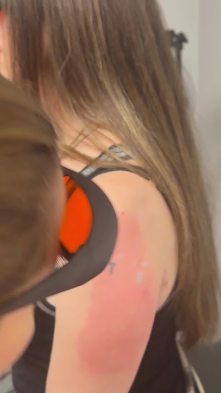 Laser Perfection — laser tattoo removal clinic in Philadelphia