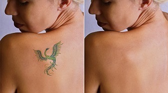 Elmira Studio | Tattoo Removal Thousand Oaks — laser tattoo removal clinic in Westlake Village