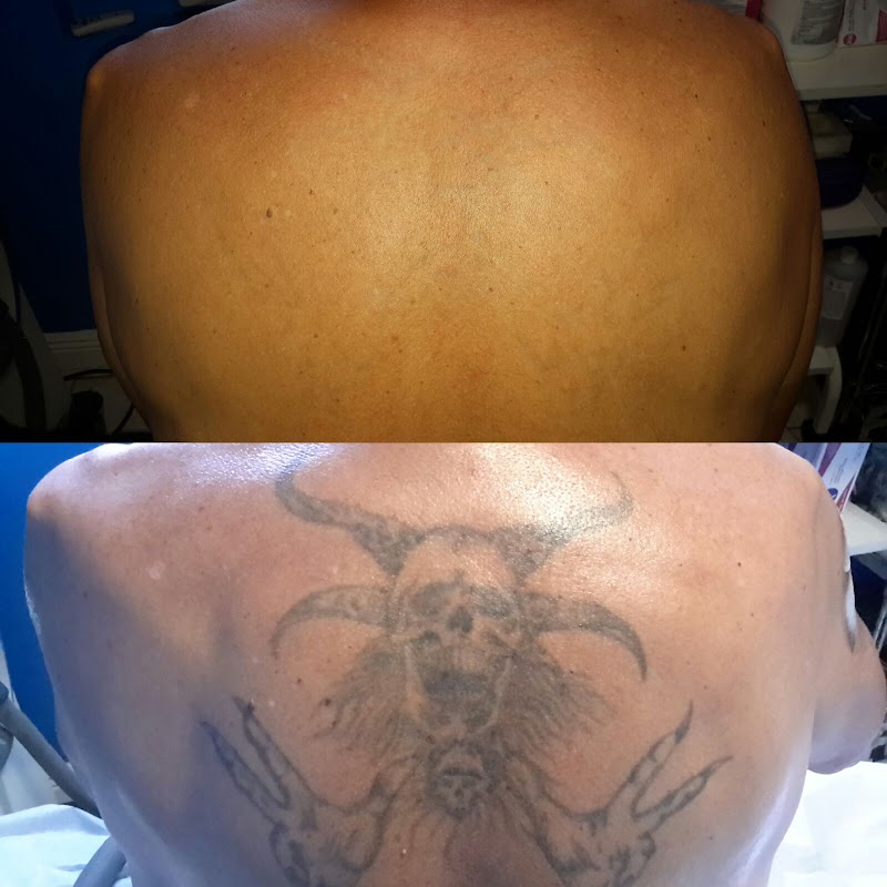 Winter Park Tattoo Removal — laser tattoo removal clinic in Winter Park