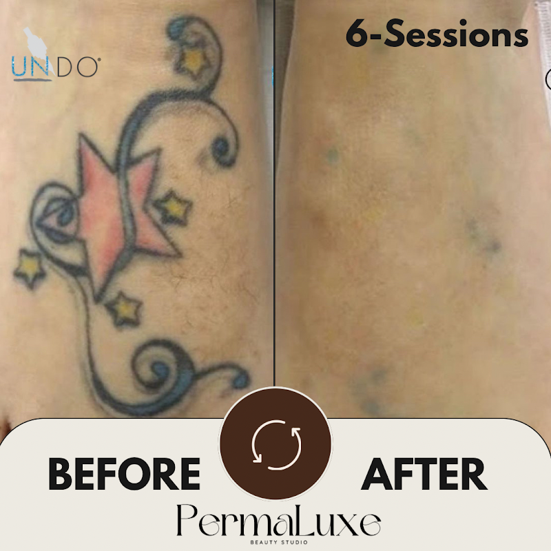 PermaLuxe — laser tattoo removal clinic in Denver