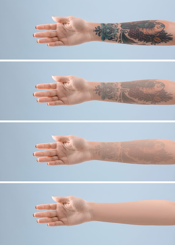 Tattoo Removal Project β laser tattoo removal clinic in Northglenn