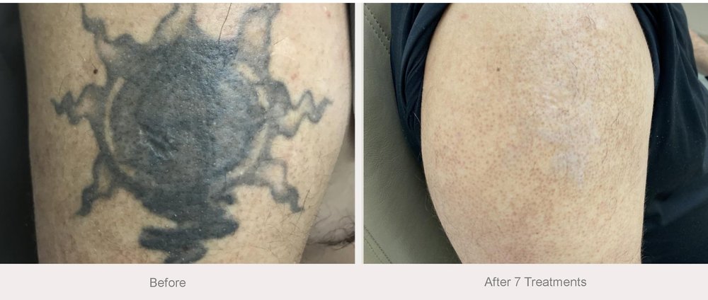 Strother Dermatology Kirkland — laser tattoo removal clinic in Kirkland
