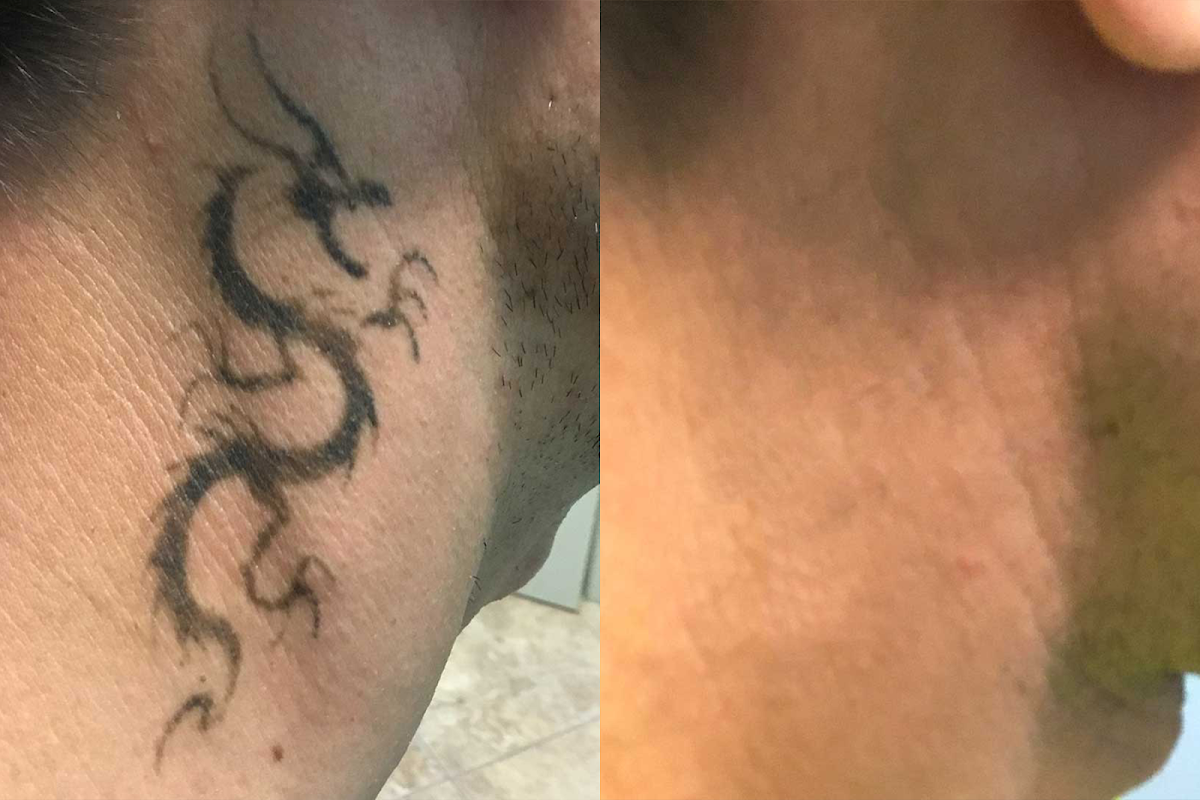 TakeTatt Tattoo Removal — laser tattoo removal clinic in New York