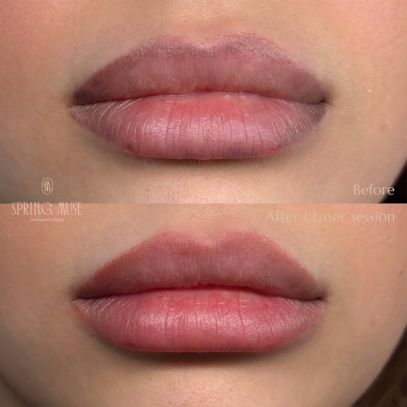 Spring Muse — laser tattoo removal clinic in New York