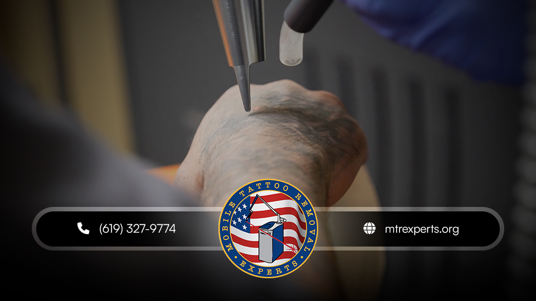 Mobile Tattoo Removal Experts β laser tattoo removal clinic in Solano County