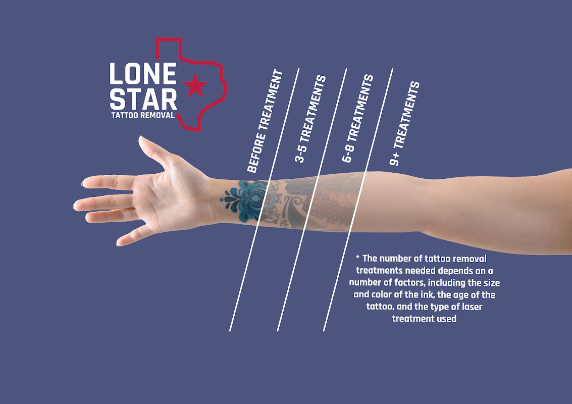 Lone Star Tattoo Removal — laser tattoo removal clinic in Dallas
